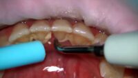 Calculus Bridge : Causes, Symptoms, and Treatment Explained 12 oral health